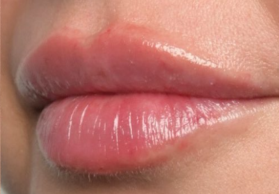 Tratamiento para labios