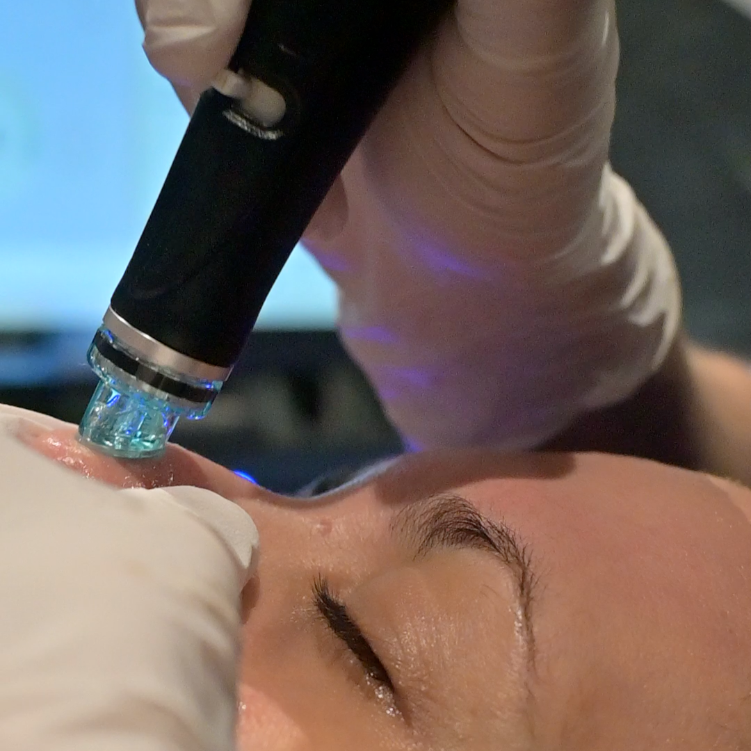 Tratamiento Hydrafacial en Madrid