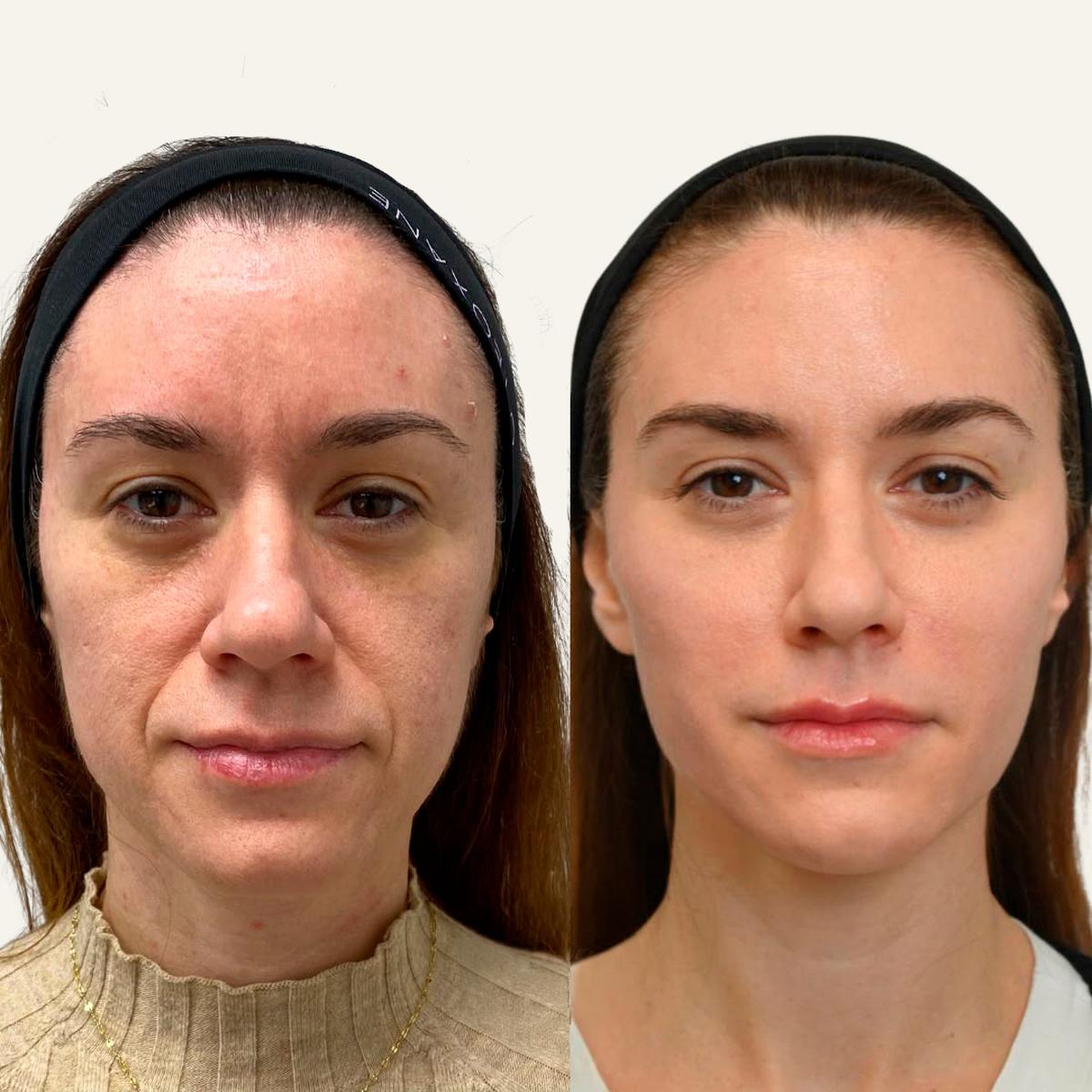 Armonización Facial