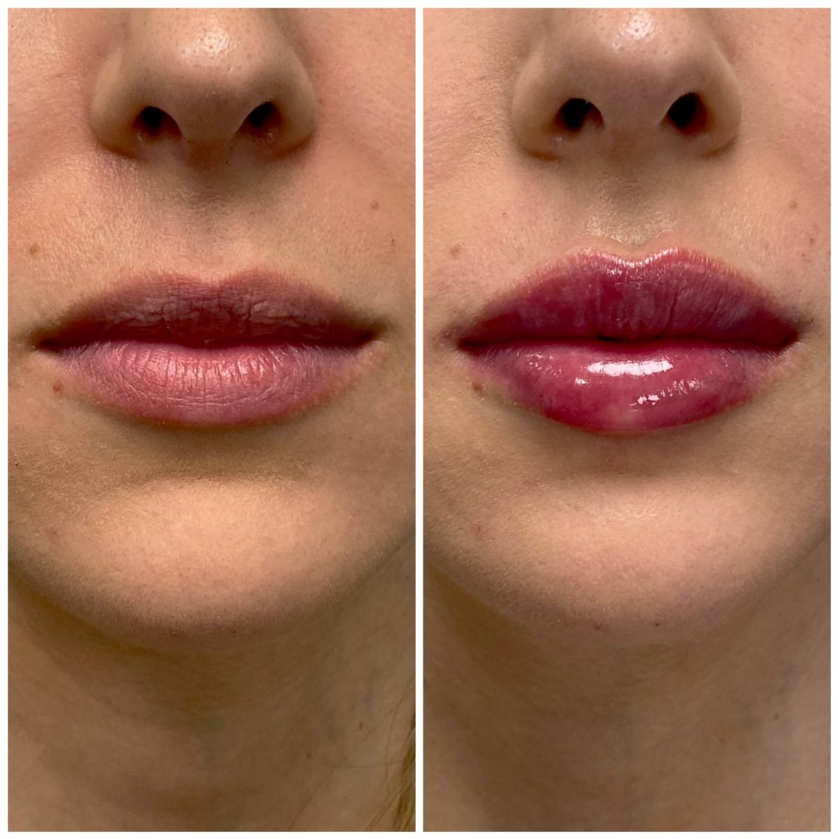 Rejuvenecimiento facial con naturalidad.