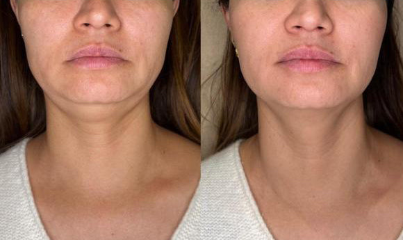 Ultherapy